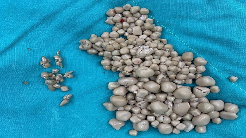 لا تحب شرب الماء.. إزالة عدد لا يصدق من «الأحجار» من كلية امرأة