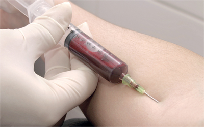 اختبار دم «ثوري» قد يكشف عن أورام المخ