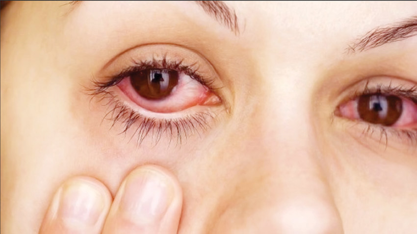 دراسة: زيت الخروع علاج علاجاً آمناً وطبيعياً محتملاً لمرض جفاف العين