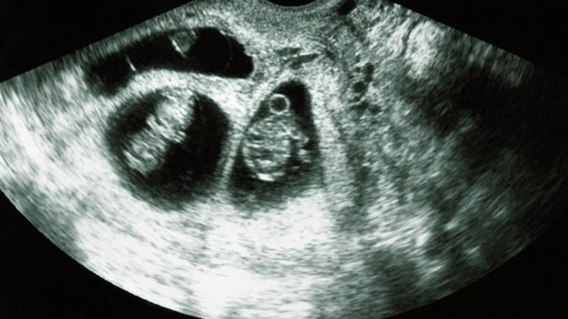 علاقة عمر الوالدين بصحة الجنين