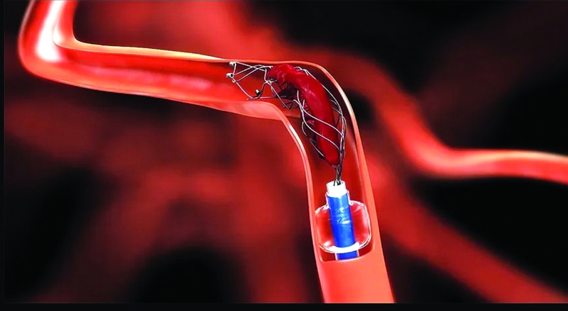 تقنية مبتكرة تحوّل خلايا الدم إلى علاج للسكتات الدماغية